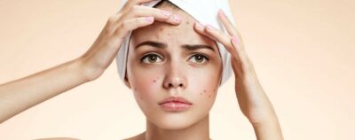 yüzde_cikan_sivilce_neyin_habercisi