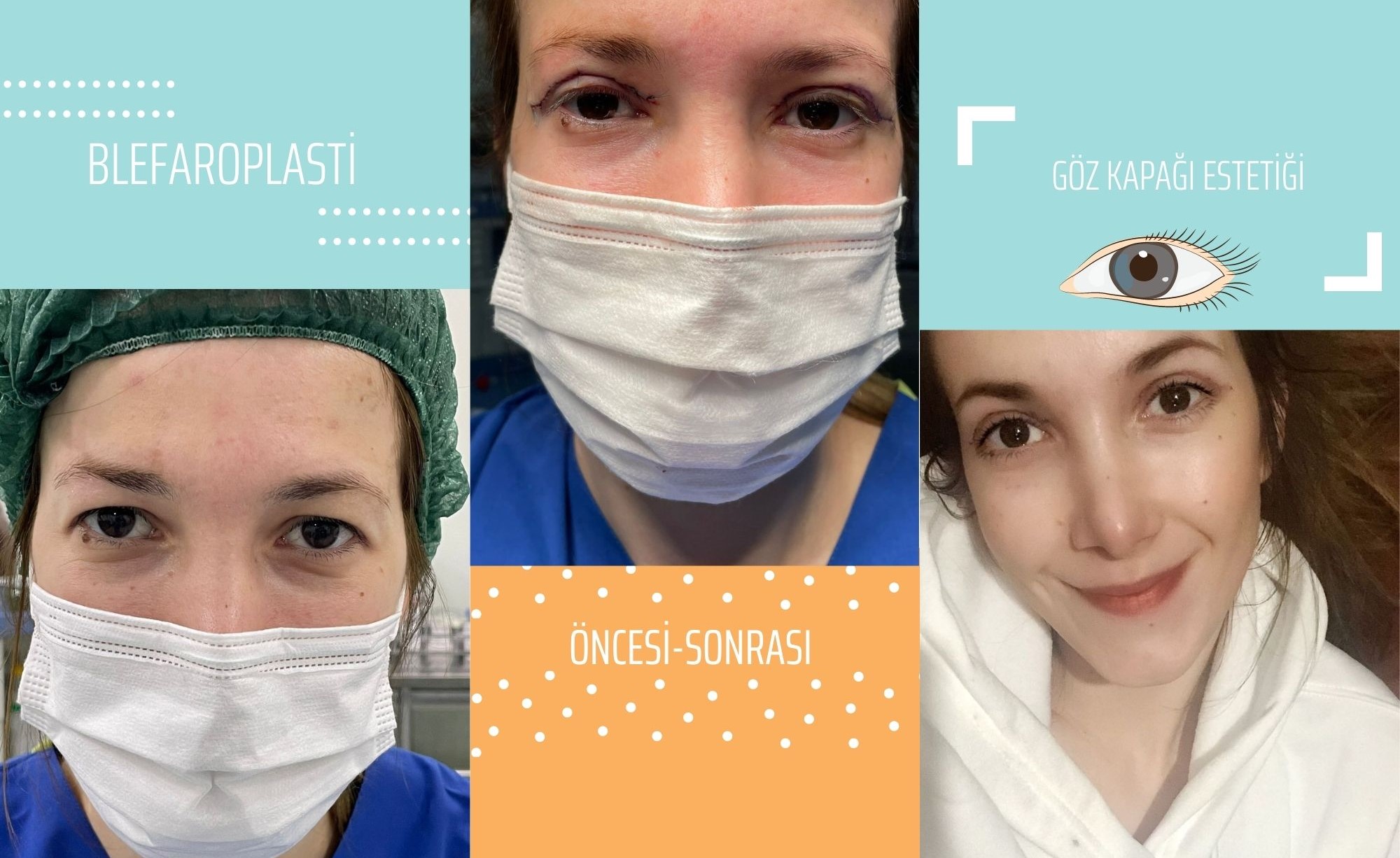 Goz Kapagi Ameliyati Blefaroplasti Yaptirdim Sinemoloji